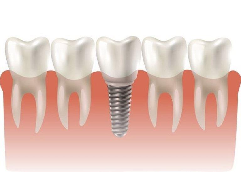 تلاش برای تولید ایمپلنت استخوانی سه بعدی توسط پژوهشگران استرالیا و آلمان