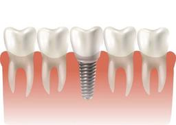 تلاش برای تولید ایمپلنت استخوانی سه بعدی توسط پژوهشگران استرالیا و آلمان