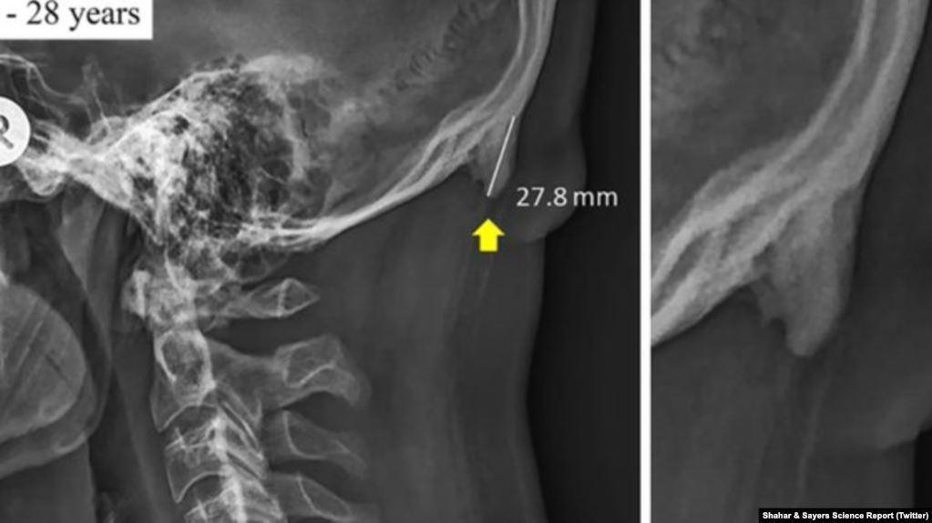 اثرات خطرناک استفاده از موبایل روی جمجمه افراد جوان