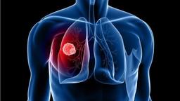 سرطان ریه ، کشنده ترین نوع بیماری سرطان در استرالیا 