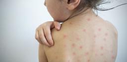 احتمال ابتلا به سرخک در پی شیوع بیماری COVID-19 بین کودکان وجود دارد