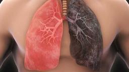 20 درصد افراد غیرسیگاری دچار سرطان ریه می‌شوند