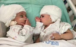 دوقلوهای بهم‌ چسبیده اسرائیلی پس از ۱۲ ساعت جداشدند