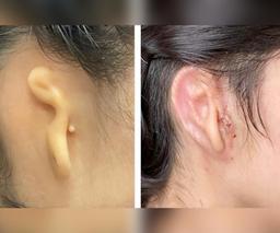 موفقیت آمیز بودن پیوند گوش ساخته شده با سلول‌های انسانی