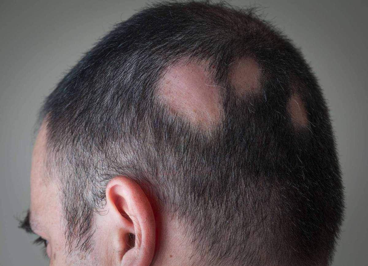 صدور مجوز داروی درمان طاسی توسط سازمان غذا و داروی آمریکا