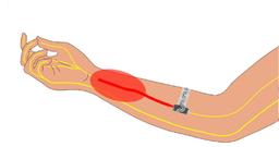 تسکین درد بدون نیاز به مواد مخدر و با یک نوار باریک