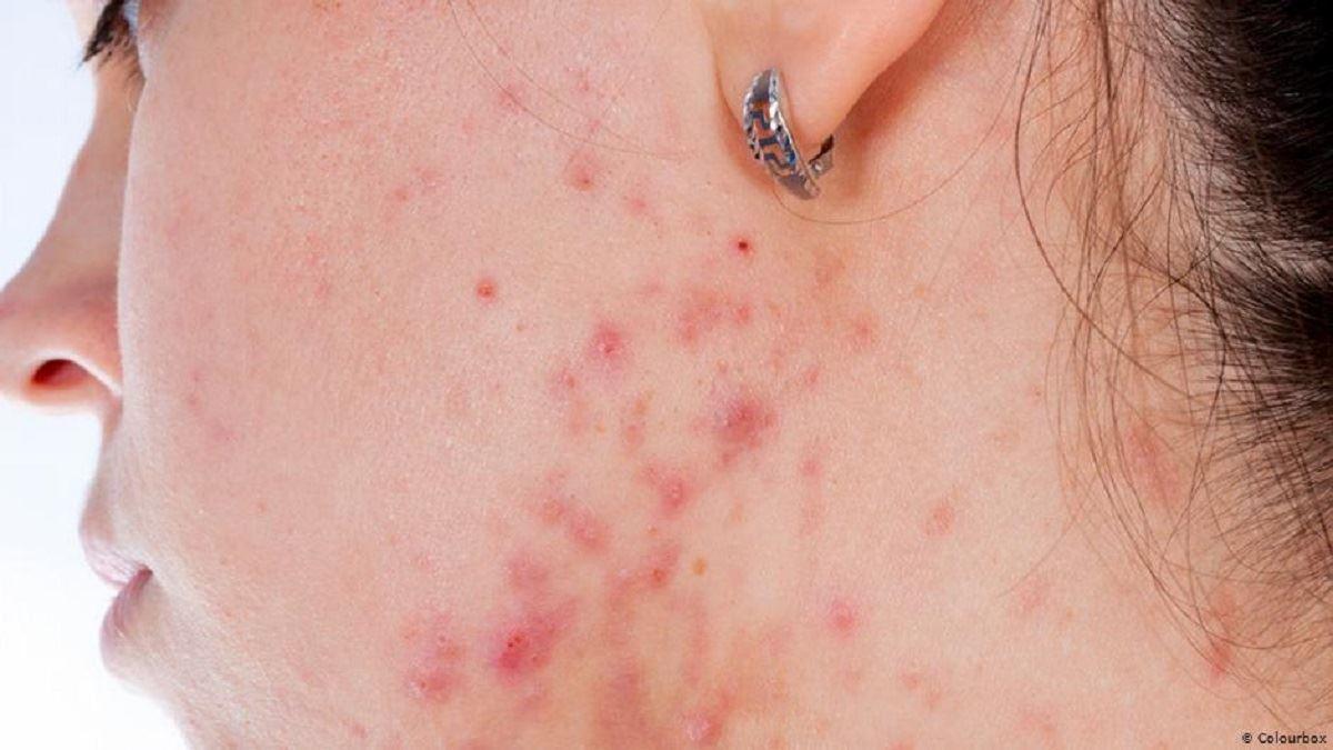 رابطه معکوس مصرف امگا۳ با جوش‌های صورت