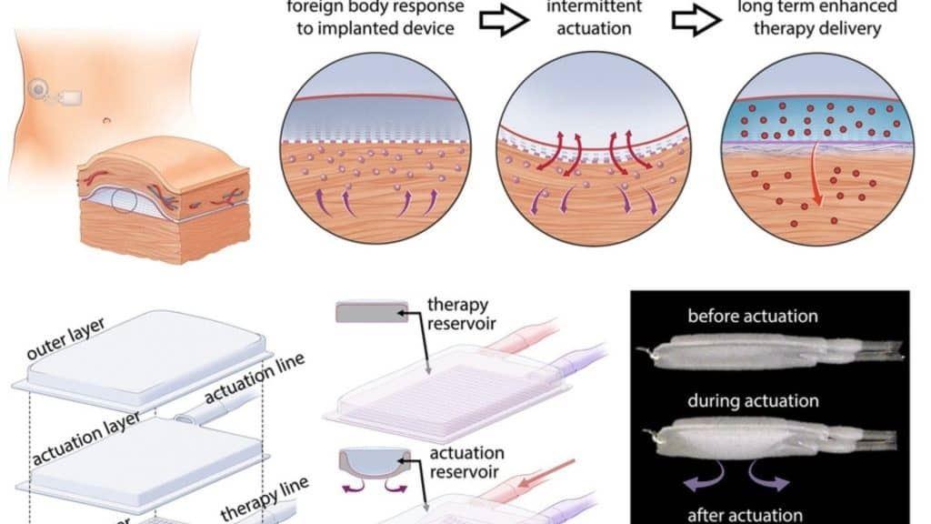 ساخت پانکراس مصنوعی برای کمک به بیماران دیابتی