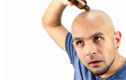 درمان طاسی با تزریق پلاسمای غنی از پلاکت