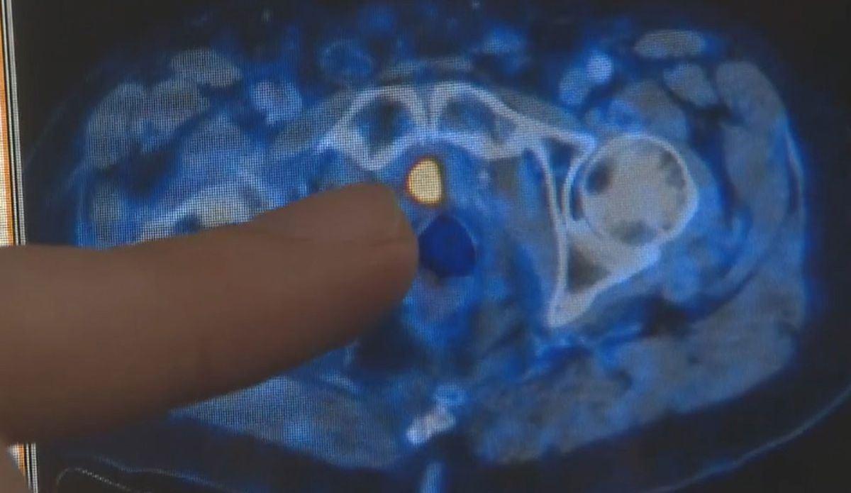 رشد مرگ و میر ناشی از سرطان پروستات در استرالیا