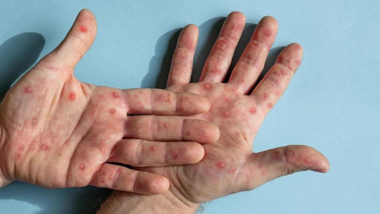 هشدار شیوع محلی ویروس آبله میمون در پایتخت ایالت ویکتوریا