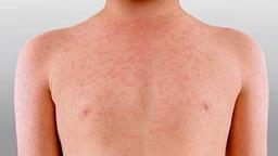 افزایش بی‌سابقه شیوع سرخک در استرالیای غربی؛ بالاترین میزان ابتلا در سه دهه اخیر