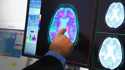 زوال عقل عامل اصلی مرگ و میر در استرالیا شناخته شد