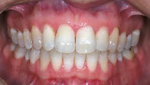 تولید اولین واکسن بیماری لثه در جهان توسط محققان ملبورن