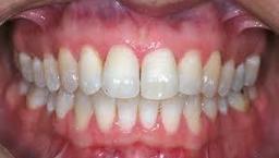 تولید اولین واکسن بیماری لثه در جهان توسط محققان ملبورن