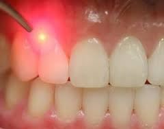 موضوع دندانپزشکی: کاربرد لیزر در دندانپزشکی و پاسخ به سوالات
