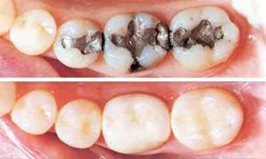 موضوع دندانپزشکی: پاسخ به سوالات ..چرا پر کردگی دندان خالی میشود ؟ ..همراه با دکتر مهرداد ابولقاسمی