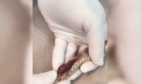  عمل جراحی قلب  یک مار در استرالیا