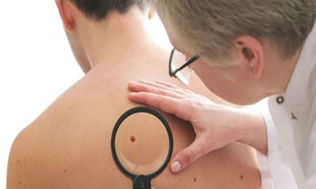  ابداع روش جدید در تشخیص زودهنگام سرطان پوست توسط دانشمندان استرالیا