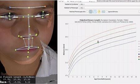 محققان استرالیا/ بیماری‌های نادر کودکان با اسکن 3بعدی چهره تشخیص داده می شود