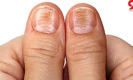 ضرورت بررسی وضعیت ناخن‌ها برای تشخیص زودهنگام سرطان پوست