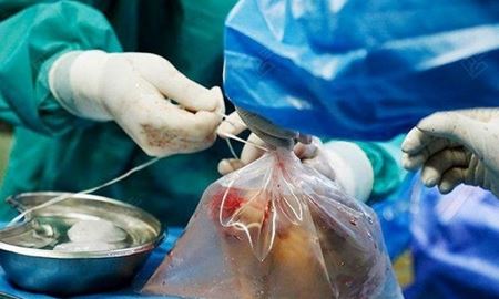 کاهش 50 درصدی اهدای عضو در ایران