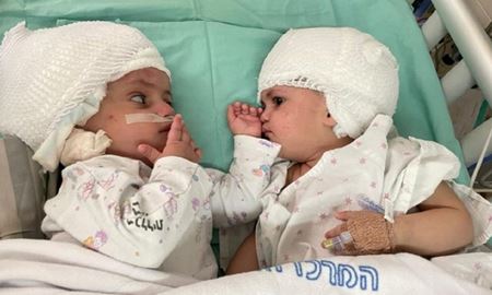 دوقلوهای بهم‌ چسبیده اسرائیلی پس از ۱۲ ساعت جداشدند