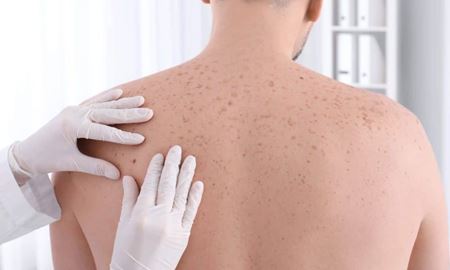درمان سرطان پوست غیرتهاجمی برای اولین‌بار در استرالیا