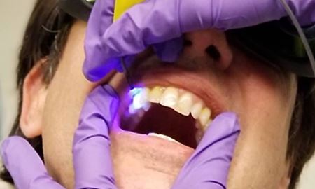 شناسایی پوسیدگی دندان با نور ال ای دی