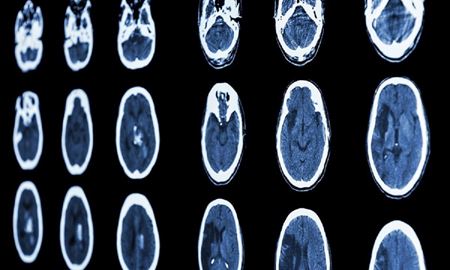 افزایش خطر ابتلا به سه بیماری مغزی در افراد مبتلا به کووید19