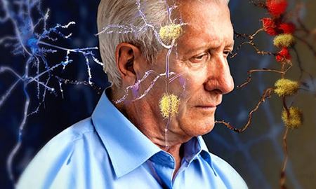 حسگرهای جدید آلمانی‌ها برای تشخیص آلزایمر 17 سال قبل از شروع