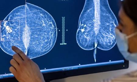 توسعه ابزارهایی برای تشخیص زودهنگام سرطان سینه با هوش مصنوعی گوگل