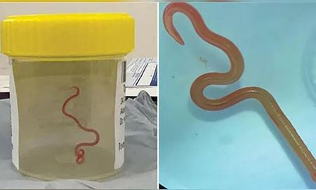 انگل پیتون از مغز یک بیمار در استرالیا بیرون آورده شد!