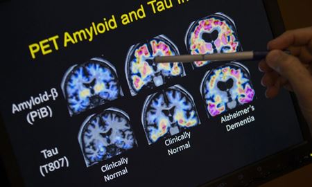 یافته‌های جدید دانشمندان استرالیایی برای درمان بیماری آلزایمر