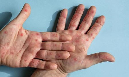 هشدار شیوع محلی ویروس آبله میمون در پایتخت ایالت ویکتوریا