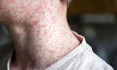 هشدارهای بهداشتی پس از شناسایی بیمار مبتلا به سرخک در گلدکوست، ایالت کوئینزلند
