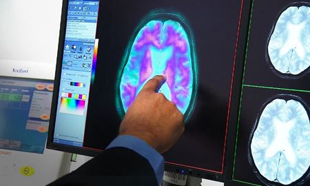 زوال عقل عامل اصلی مرگ و میر در استرالیا شناخته شد